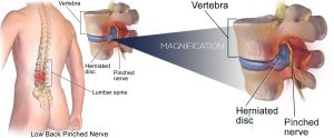 Diagnosed With a Herniated Disc? Get the facts on what really causes it and how to get relief